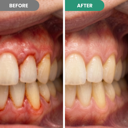 GT Teeth Repair Pen